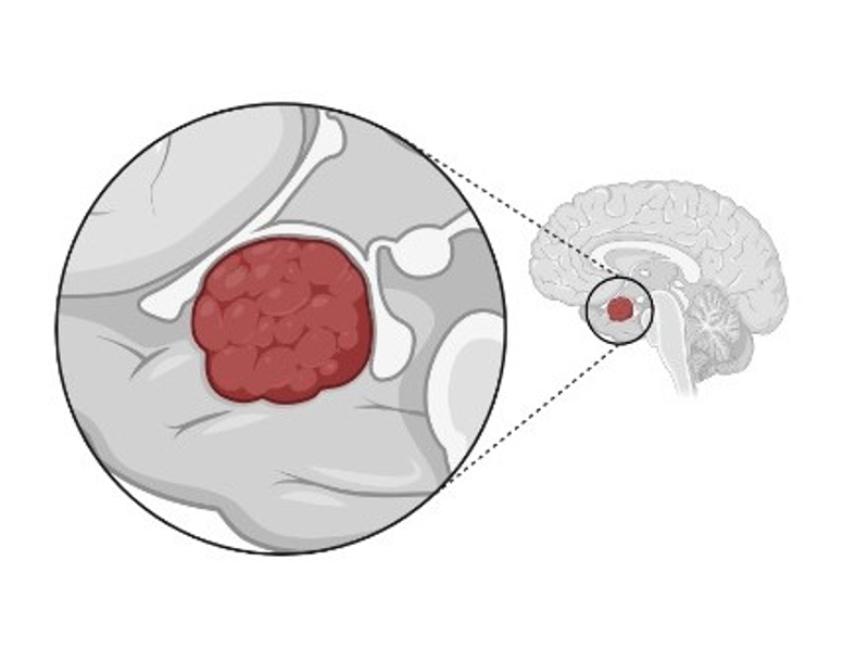 Neurological Disorders